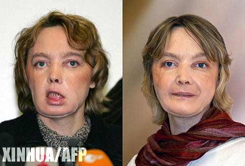 这是法国患者伊莎贝尔·迪努瓦尔在换脸手术后恢复情况的拼版照片，左图拍摄于2006年2月6日，右图拍摄于2006年11月。2005年11月27日，法国里昂大学和亚眠大学附属医院的医务人员为这名患者实施了换脸手术，使她得到了新鼻子、新嘴唇和新下巴。一年后，这家法国医院发表了近日为患者拍摄的最新照片，并发表公报宣布手术效果令人满意。
