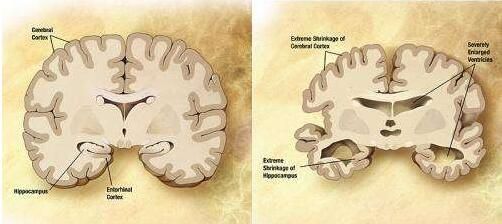 Neurology:重磅!首次发现细菌会直接影响阿尔兹海默式症的疾病进展